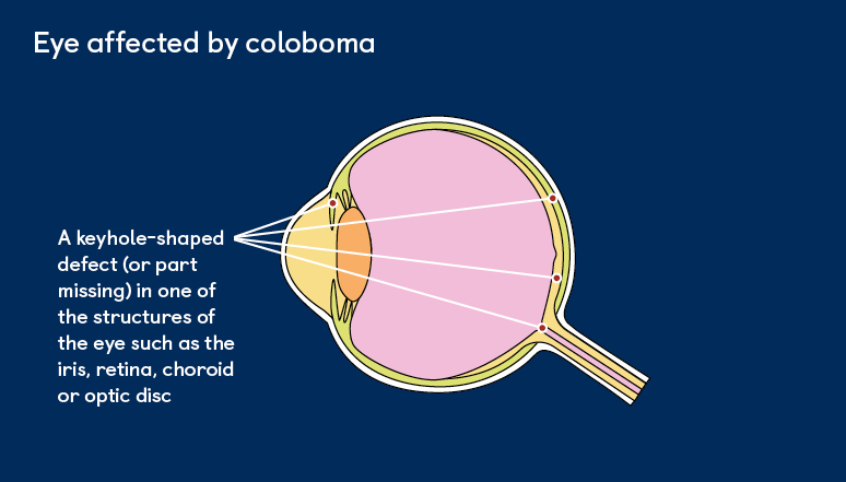 coloboma of the eye