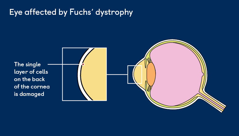 Fuchs' Dystrophy | Your Eye Health