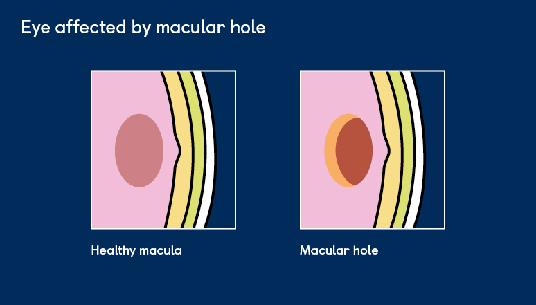 A diagram of a healthy macula and a macular hole. The diagram of a macular hole shows a tear or gap in the macula at the centre of the retina, causing blurred or distorted vision.